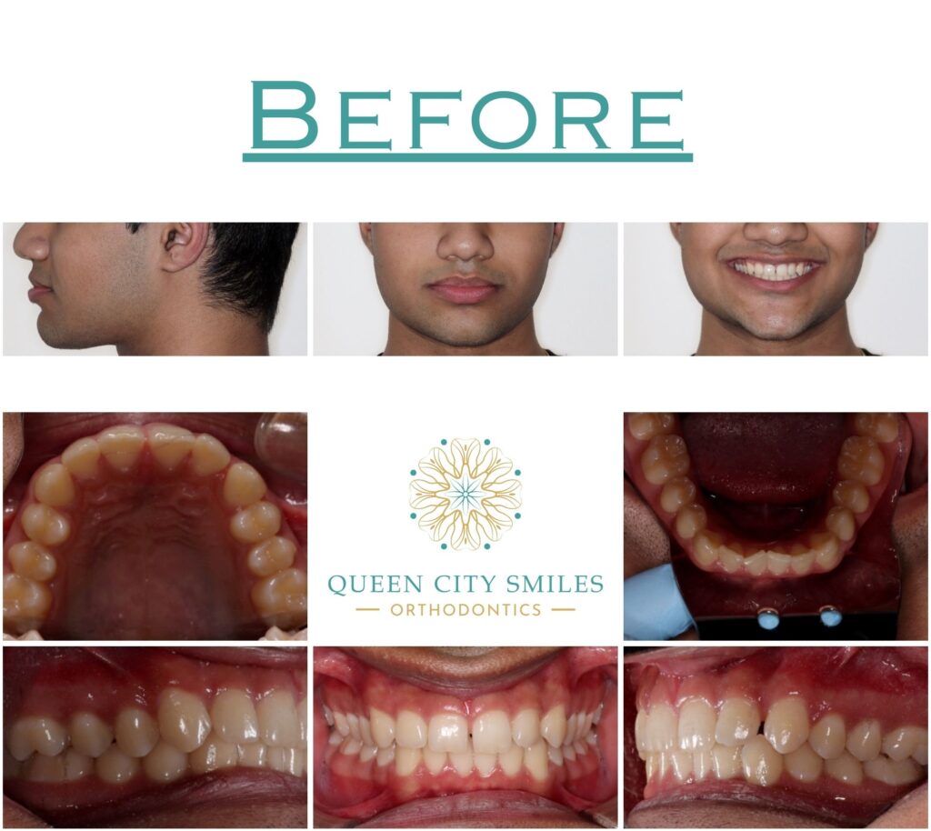 160 Before Treatment Li