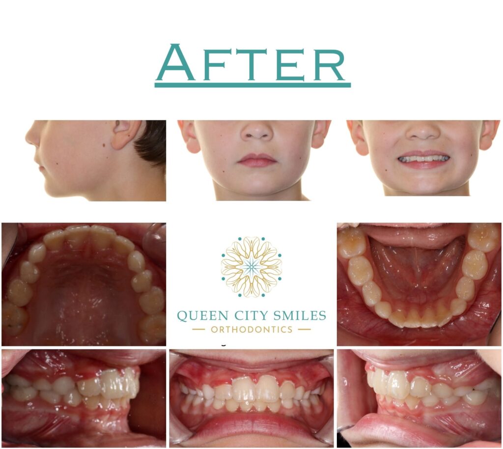 236 After Treatment Lb