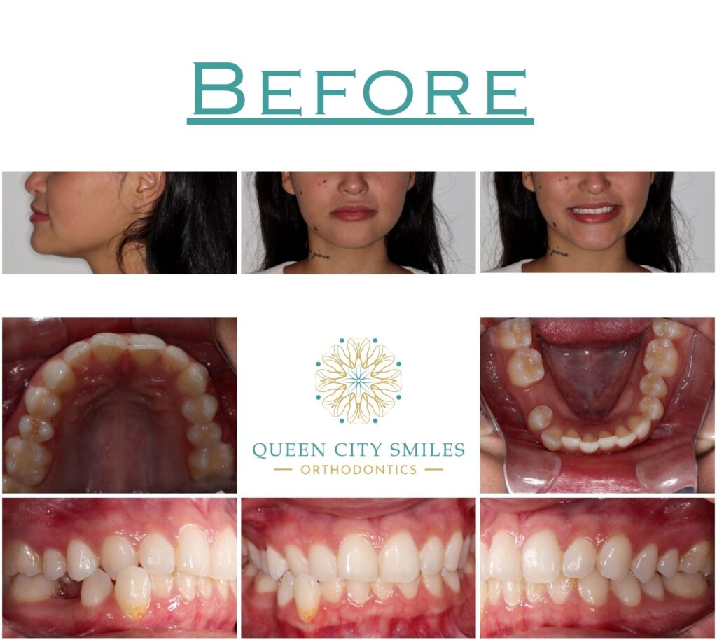 244 Before Treatment