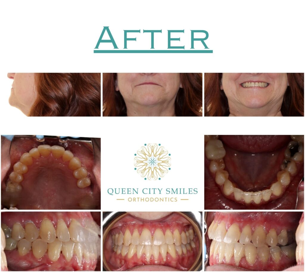 62 After Treatment Comp