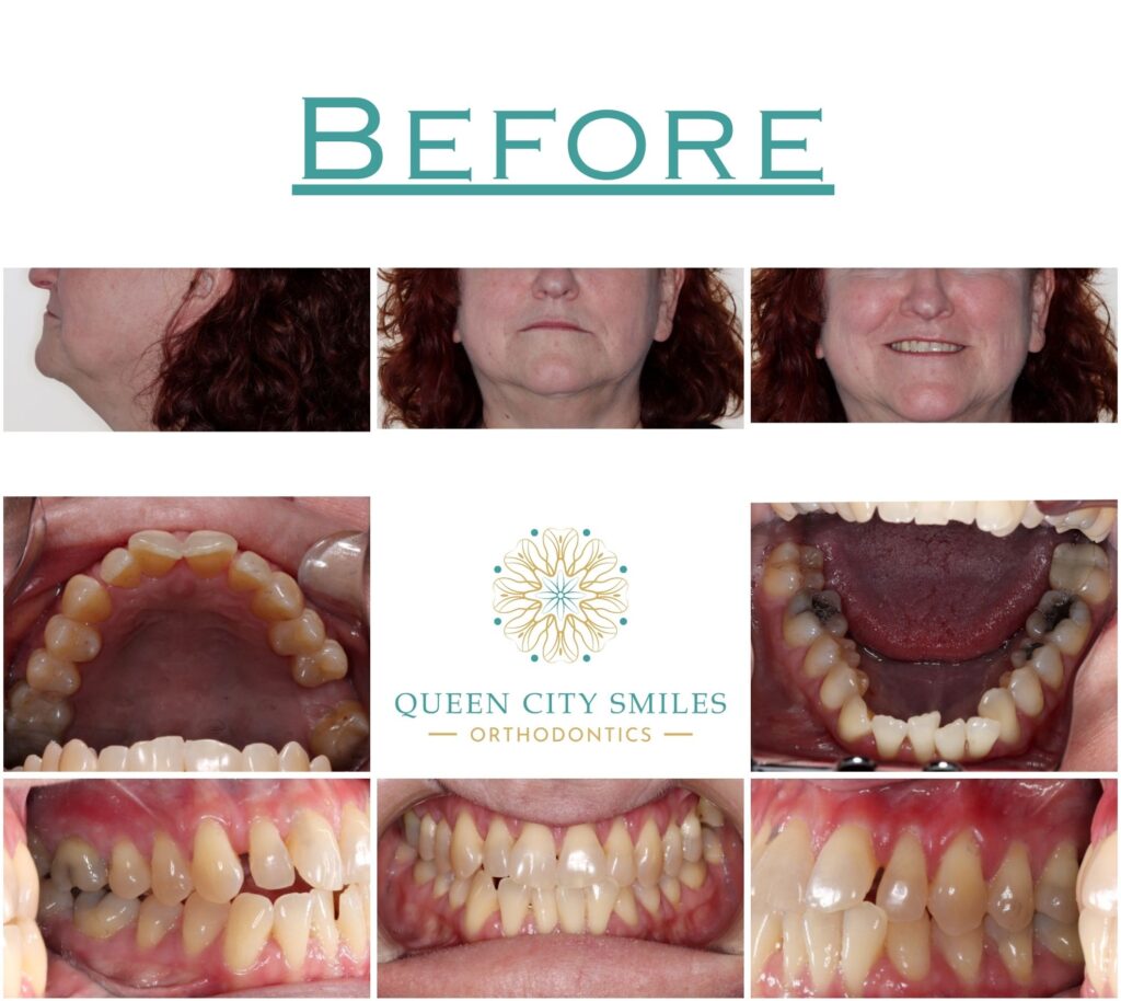 62 Before Treatment Comp
