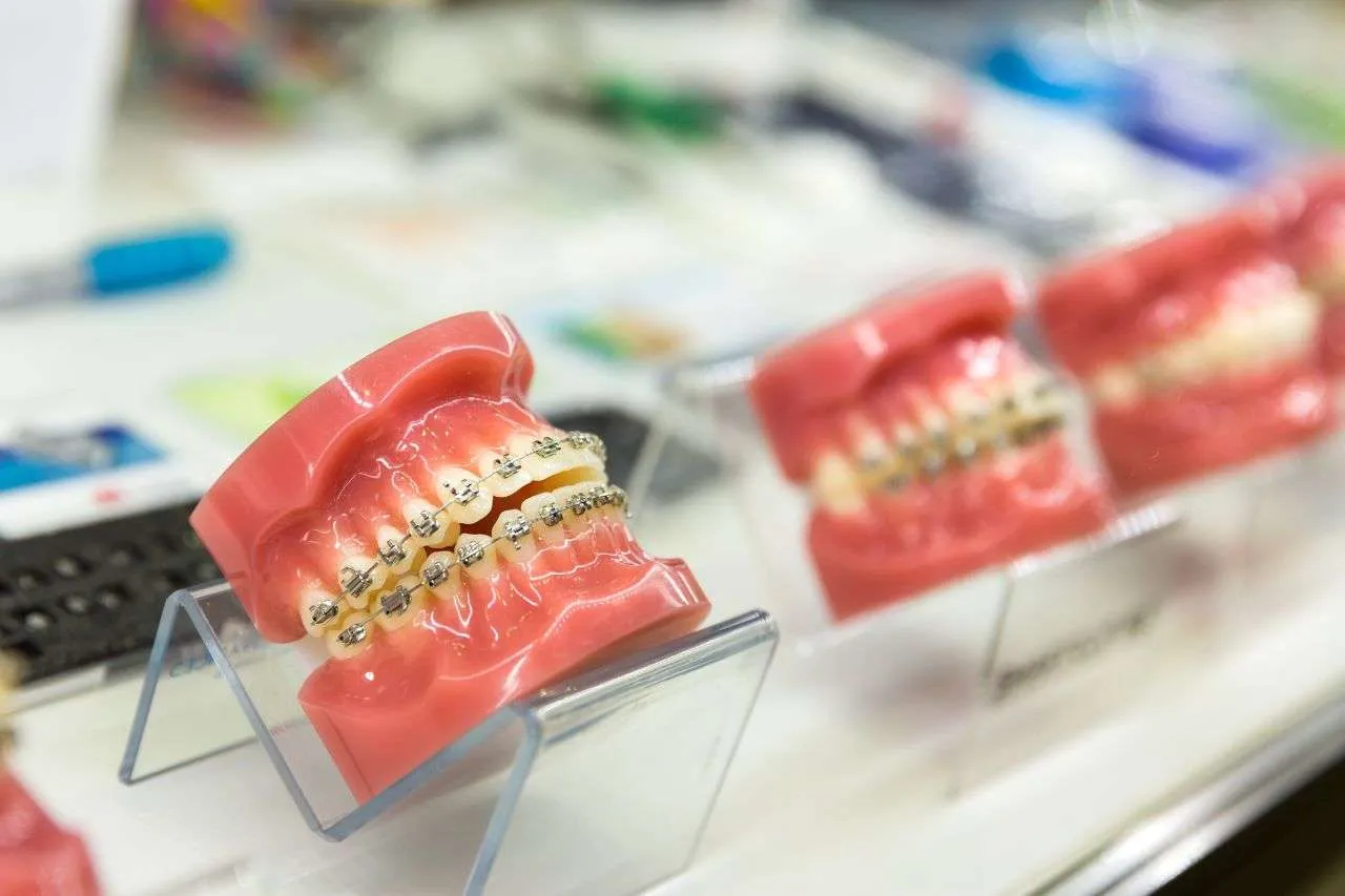 Different Types Of Braces Including Metal, Ceramic, Lingual, And Clear Aligners