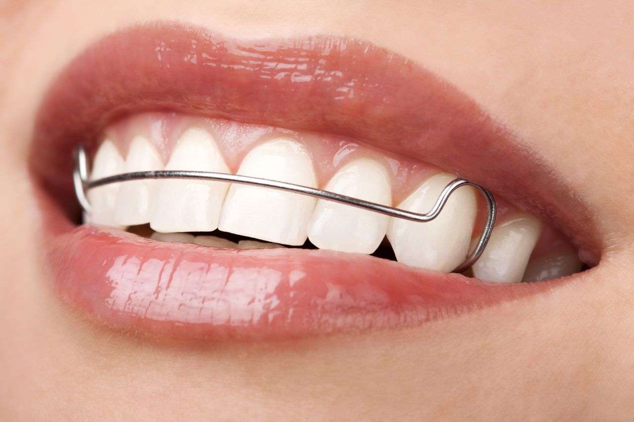 Clear Orthodontic Retainer Placed On Teeth To Maintain Alignment After Braces
