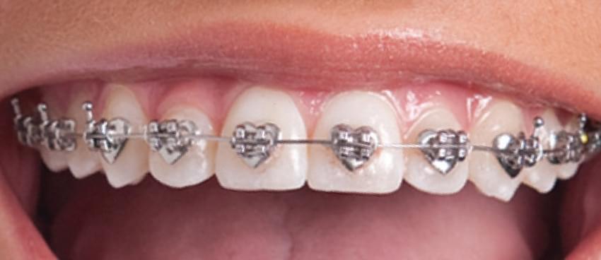Braces Queen City Smiles Orthodontics In Charlotte, Nc