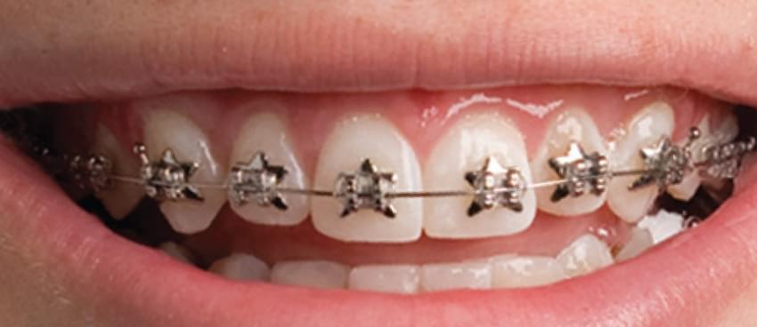 Wlds Queen City Smiles Orthodontics In Charlotte, Nc