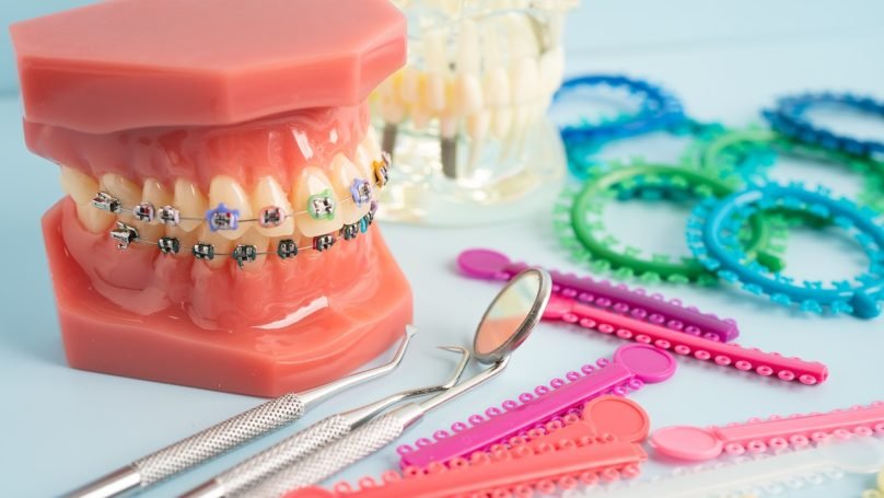 orthodontic-ligatures-rings-and-ties-elastic-rubb-2025-02-25-22-42-24-utc Orthodontic ligatures rings and ties, elastic rubber bands on orthodontic braces, model for dentist studying about dentistry.